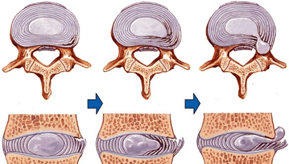 poškodbe hrbtenice pri osteohondrozi