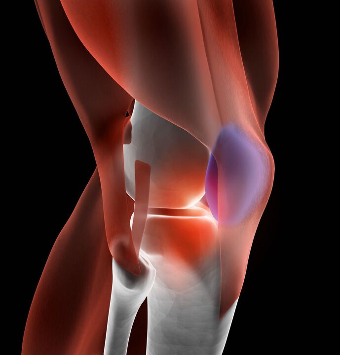 artroza kolena