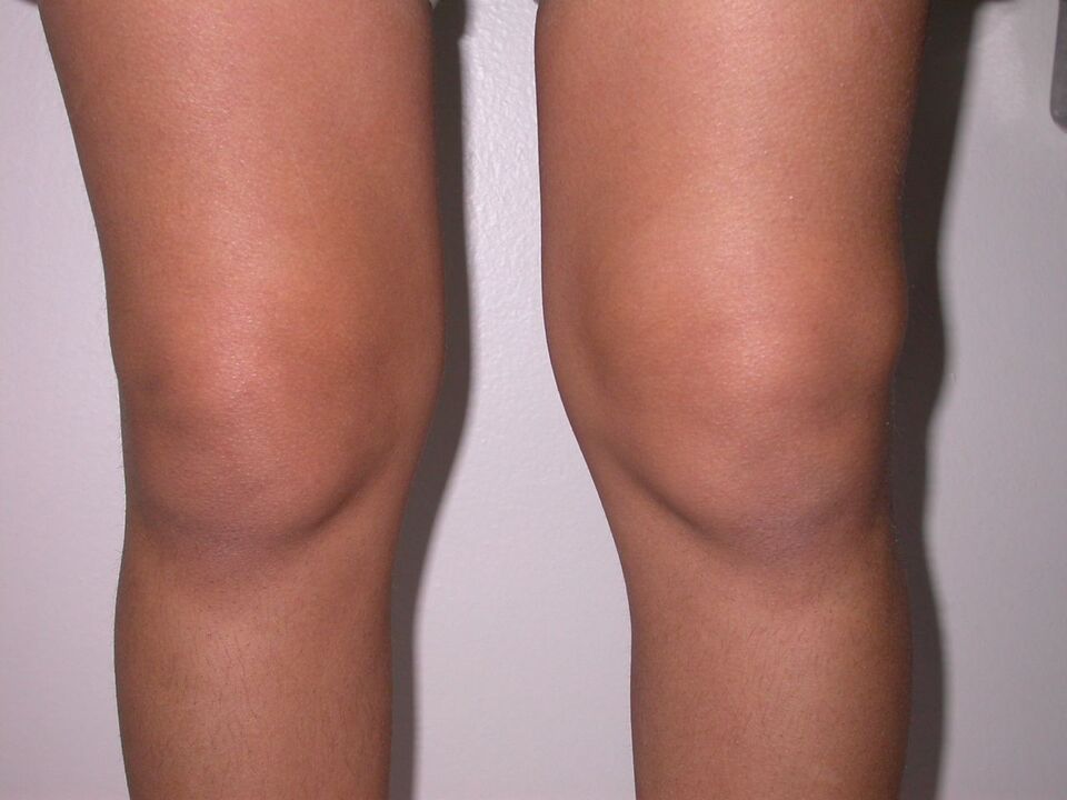 otekanje kolena zaradi osteoartritisa