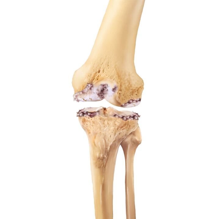 uničenje kolenskega sklepa z artrozo
