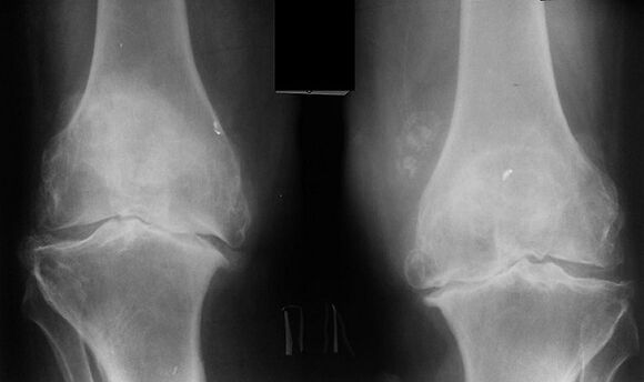 X -ray kot način diagnosticiranja artroze kolenskega sklepa