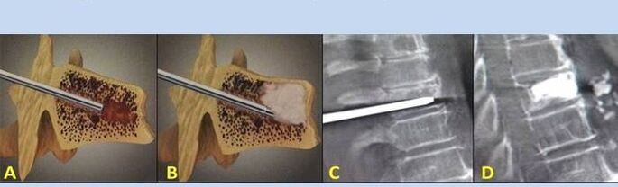 punkcijska vertebroplastika za bolečine v hrbtu