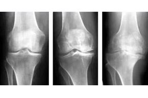 faze artroze sklepa na rentgenskem posnetku