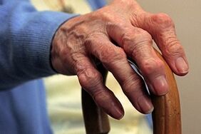 poškodbe prstov z artrozo