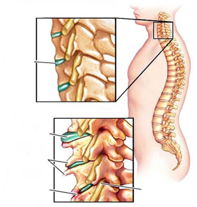 osteohondroza in zdrava vratna hrbtenica