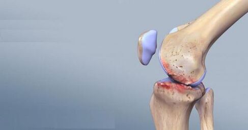Artroza kolena