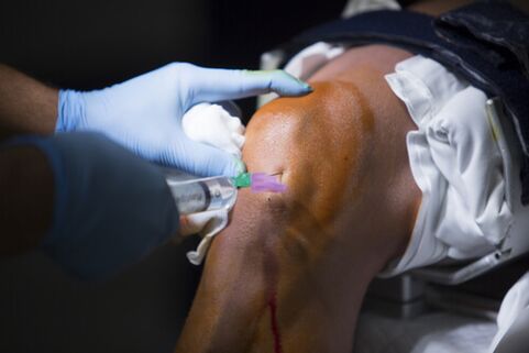 Injekcije v kolenski sklep zaradi artroze