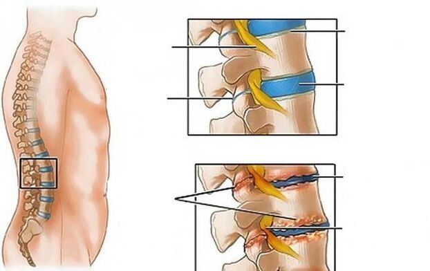 osteohondroza ledvene hrbtenice povzroča bolečine v hrbtu