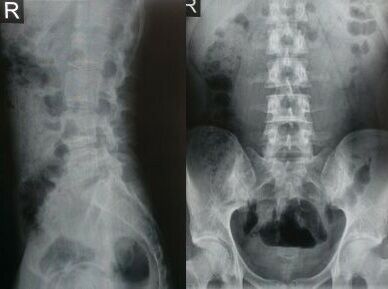 rentgen ledvene hrbtenice